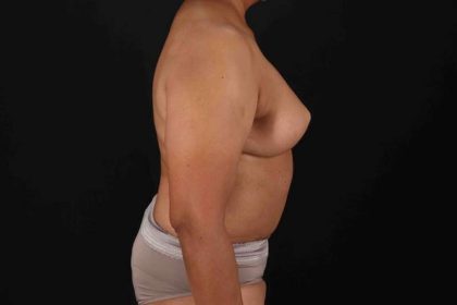 Breast Reconstruction Before & After Patient #10914