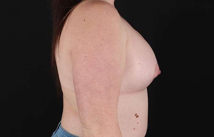 Breast Augmentation with Implants Before & After Patient #10870