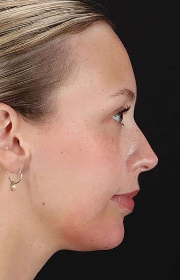 Fillers Before & After Patient #13309