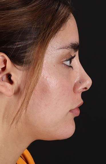 Fillers Before & After Patient #13287