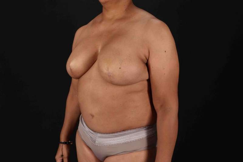 Breast Reconstruction Before & After Patient #10914