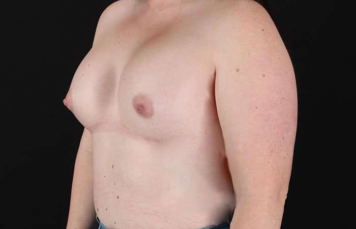 Breast Augmentation with Implants Before & After Patient #10870