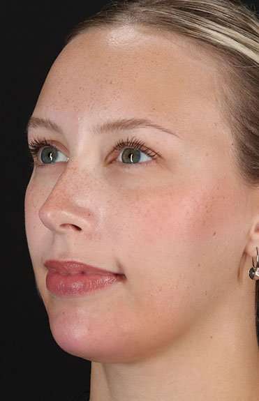 Fillers Before & After Patient #13309