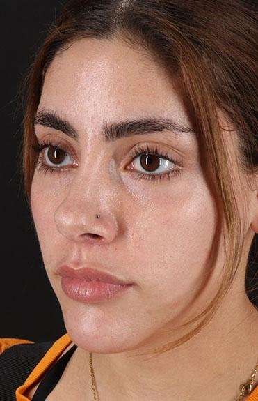 Fillers Before & After Patient #13287