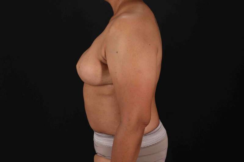 Breast Reconstruction Before & After Patient #10914