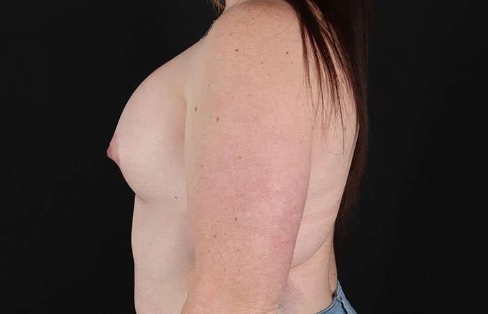 Breast Augmentation with Implants Before & After Patient #10870