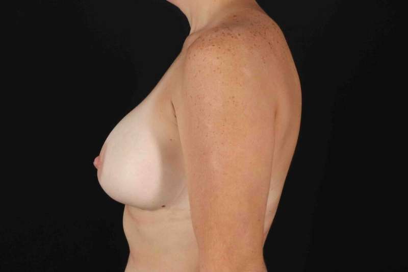 Breast Augmentation with Implants Before & After Patient #10881