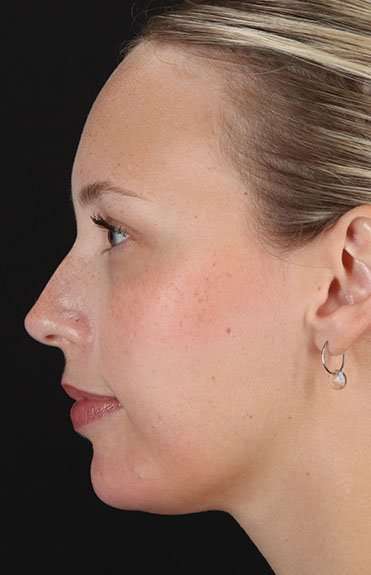 Fillers Before & After Patient #13309