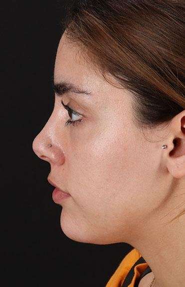 Fillers Before & After Patient #13287