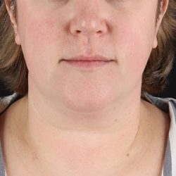 Submental Liposuction Before & After Patient #10505