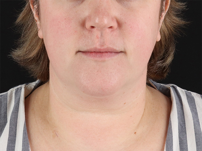 Submental Liposuction Before & After Patient #10505