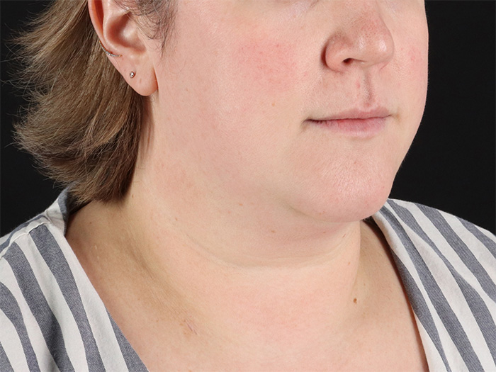 Submental Liposuction Before & After Patient #10505