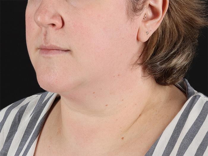 Submental Liposuction Before & After Patient #10505