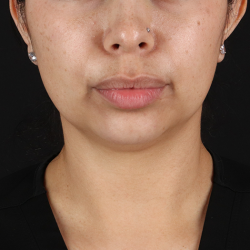Submental Liposuction Before & After Patient #10494