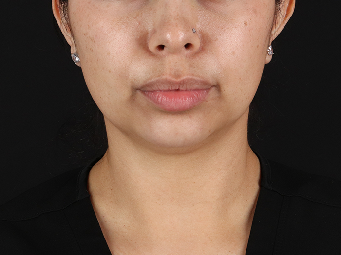 Submental Liposuction Before & After Patient #10494