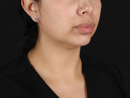 Submental Liposuction Before & After Patient #10494