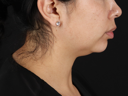 Submental Liposuction Before & After Patient #10494