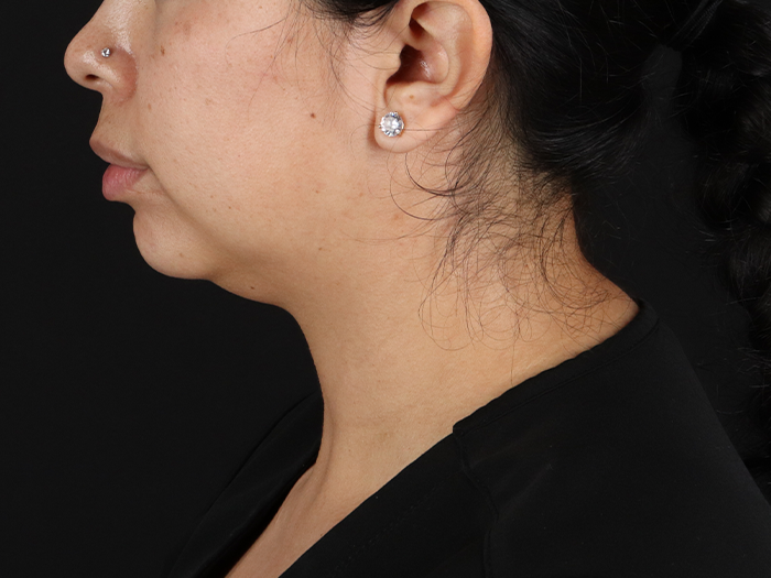 Submental Liposuction Before & After Patient #10494