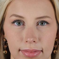 Fillers Before & After Patient #13309