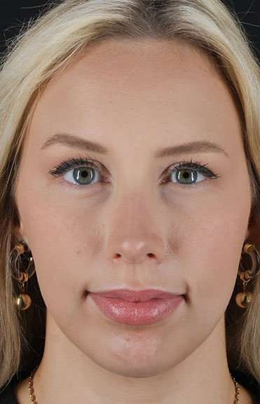 Fillers Before & After Patient #13309