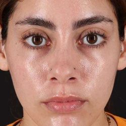 Fillers Before & After Patient #13287