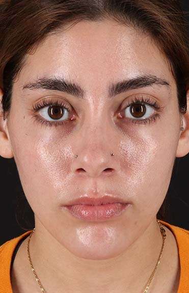 Fillers Before & After Patient #13287