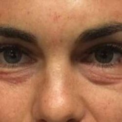 Fillers Before & After Patient #13273