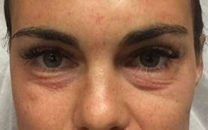 Fillers Before & After Patient #13273