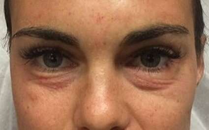 Fillers Before & After Patient #13273
