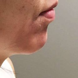 Fillers Before & After Patient #13270