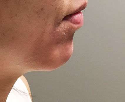 Fillers Before & After Patient #13270