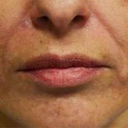 Fillers Before & After Patient #13267