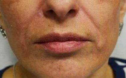 Fillers Before & After Patient #13267
