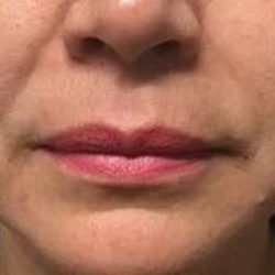 Fillers Before & After Patient #13264
