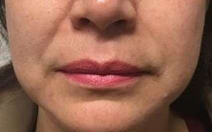 Fillers Before & After Patient #13264