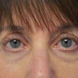 Fillers Before & After Patient #13261