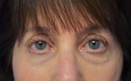 Fillers Before & After Patient #13261