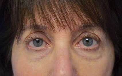 Fillers Before & After Patient #13261