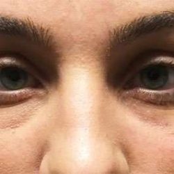 Fillers Before & After Patient #13258