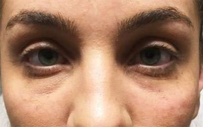 Fillers Before & After Patient #13258