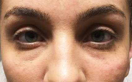 Fillers Before & After Patient #13258