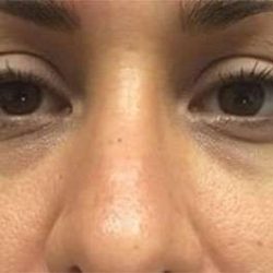 Fillers Before & After Patient #13255