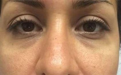 Fillers Before & After Patient #13255