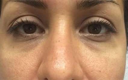 Fillers Before & After Patient #13255