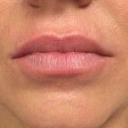 Fillers Before & After Patient #13243