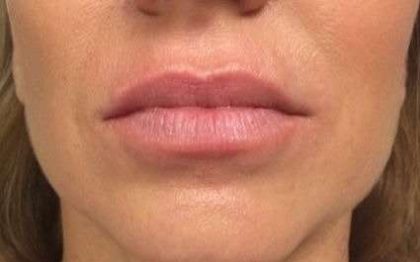 Fillers Before & After Patient #13243