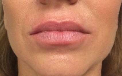 Fillers Before & After Patient #13243