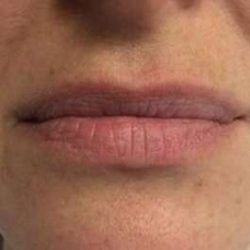 Fillers Before & After Patient #13240