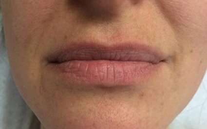 Fillers Before & After Patient #13240