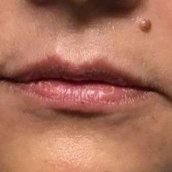 Fillers Before & After Patient #13237